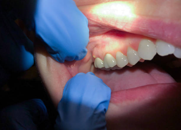 Best Same-Day Emergency Dental Services in Salado, TX