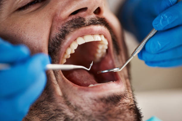 Best Emergency Wisdom Teeth Removal in Salado, TX